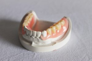 Prothèse dentaire Amovible